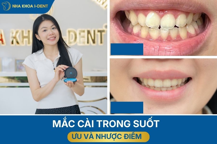 các loại mắc cài