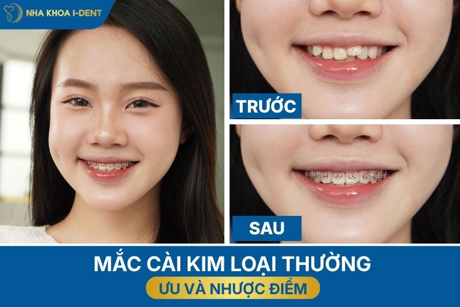các loại mắc cài niềng răng