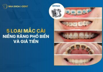 5 loại Mắc cài niềng răng phổ biến hiện nay và giá tiền