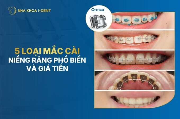 5 loại Mắc cài niềng răng phổ biến hiện nay và giá tiền