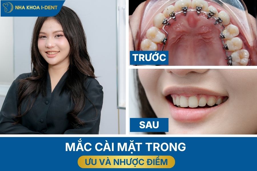 các loại niềng răng mắc cài