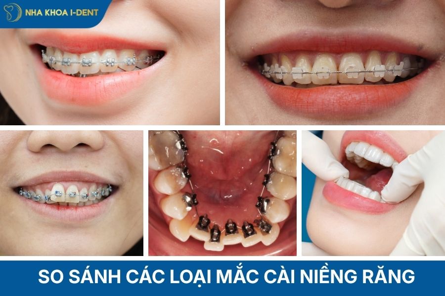 các loại mắc cài niềng răng và giá tiền