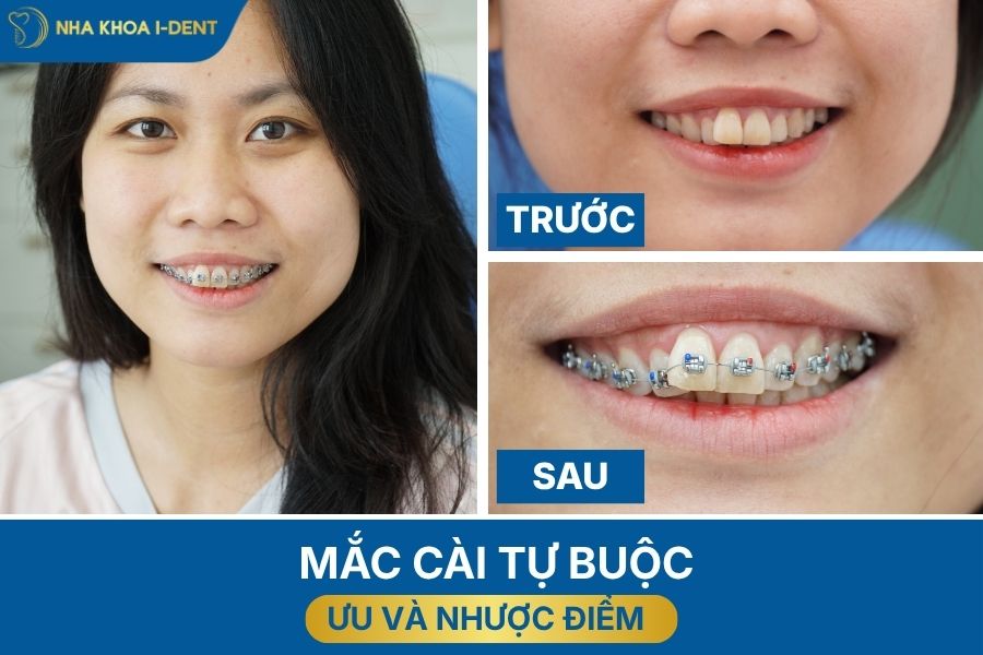 các loại mắc cài trong niềng răng