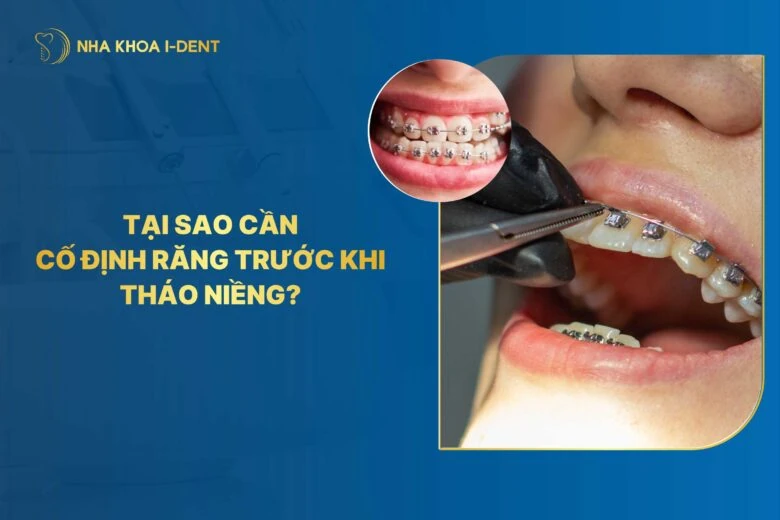 [Giải đáp] Tại sao cần cố định răng trước khi tháo niềng?