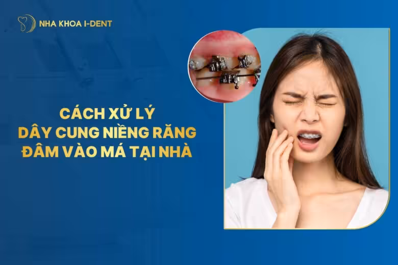 Nguyên nhân và cách xử lý dây cung niềng răng đâm vào má
