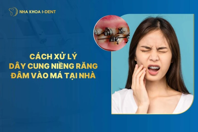 Nguyên nhân và cách xử lý dây cung niềng răng đâm vào má
