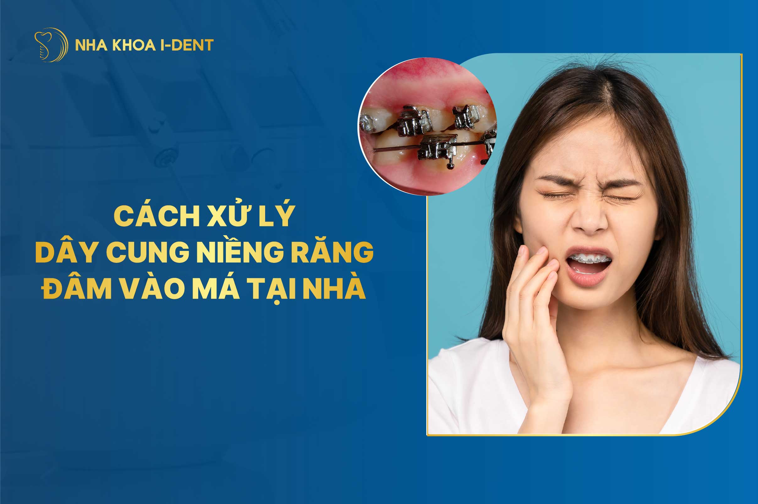 Nguyên nhân và cách xử lý dây cung niềng răng đâm vào má