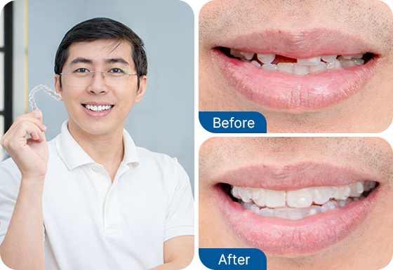 invisalign clear aligners