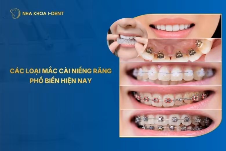 Các Loại Mắc Cài