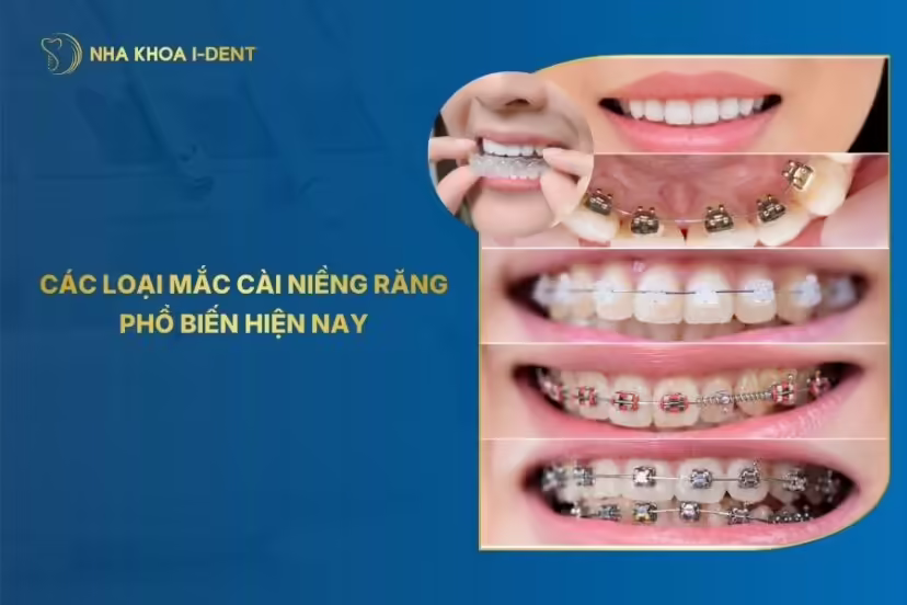 Các Loại Mắc Cài