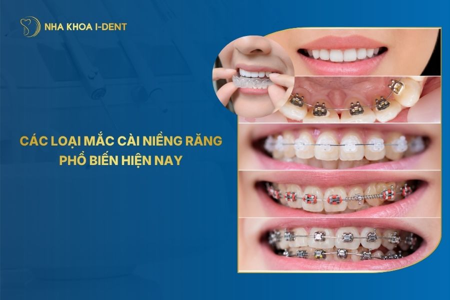 5 Loại mắc cài niềng răng phổ biến nhất hiện nay