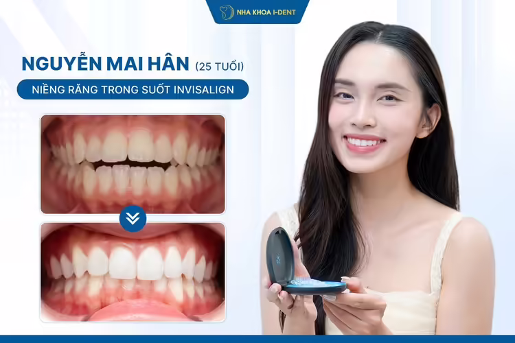 Khách hàng niềng răng Invisalign