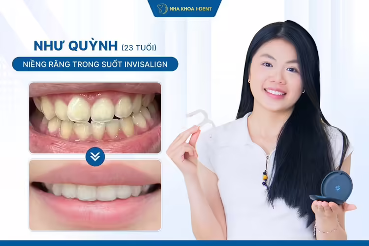Khách hàng Như Quỳnh niềng răng invisalign