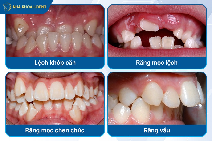niềng mắc cài kim loại