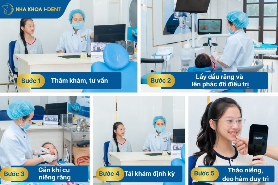 niềng răng cho bé