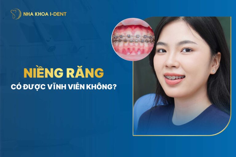 Niềng răng có được vĩnh viễn không? chuyên gia giải đáp