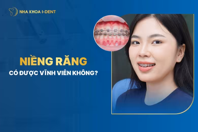 Niềng răng có được vĩnh viễn không? chuyên gia giải đáp