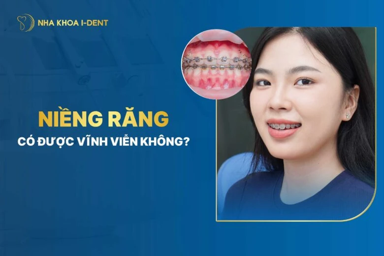 Niềng răng có được vĩnh viễn không? chuyên gia giải đáp