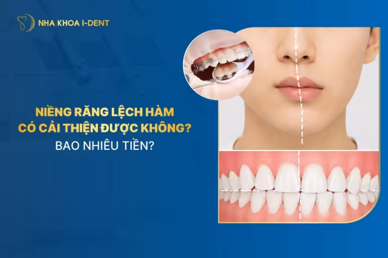 Niềng răng lệch hàm có cải thiện được không? Bao nhiêu tiền?