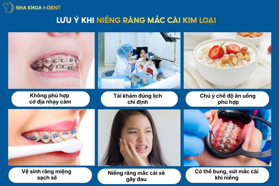 niềng răng mắc cài kim loại là gì