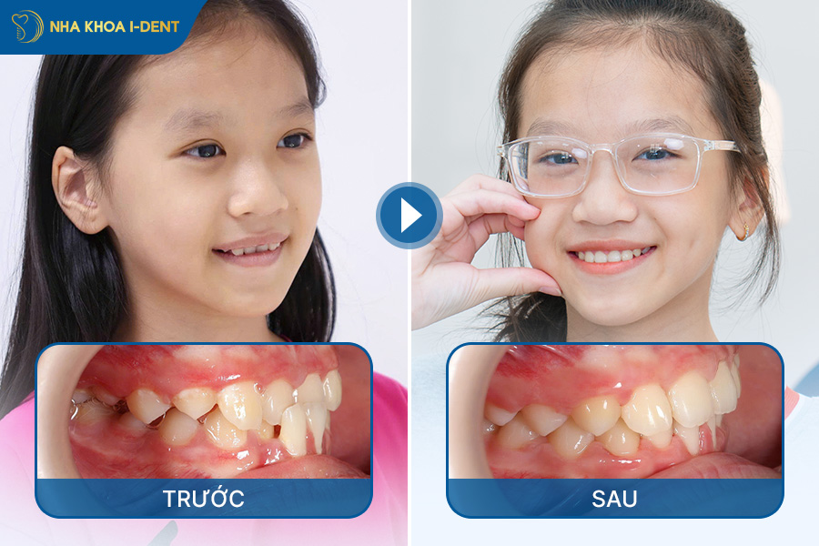 niềng răng mắc cài kim loại cho trẻ em