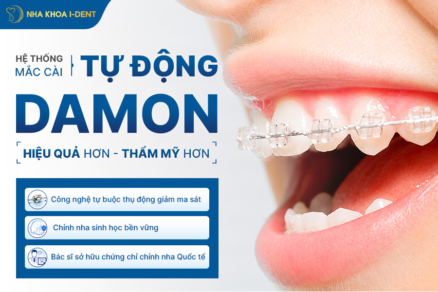 niềng răng mắc cài tự động damon