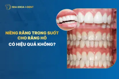 niềng răng trong suốt cho răng hô