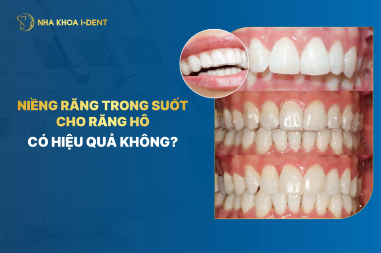 niềng răng trong suốt cho răng hô