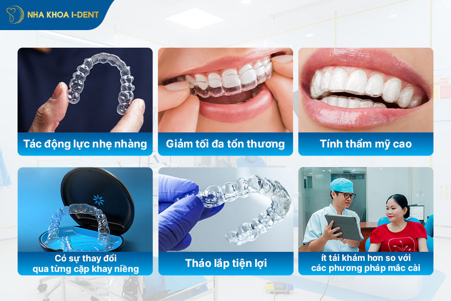 niềng răng trong suốt cho răng hô