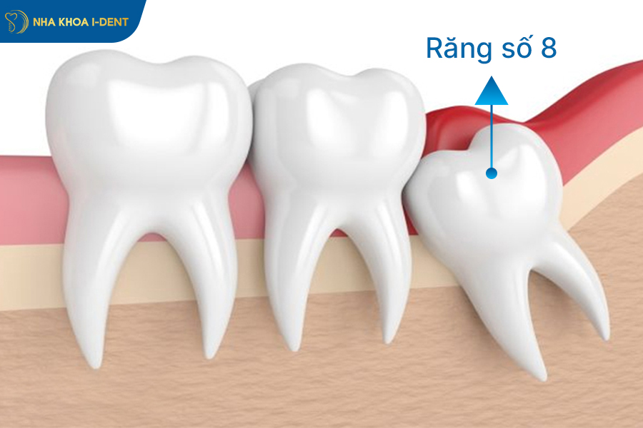 quy trình nhổ răng khôn 
