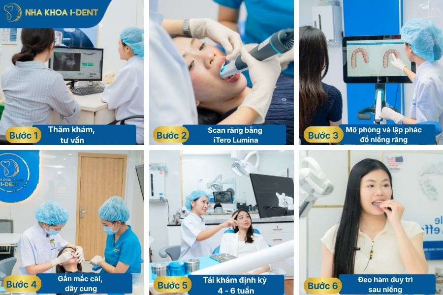 mắc cài niềng răng hiện nay