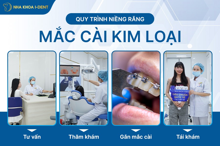 quy trình niềng răng mắc cài kim loại