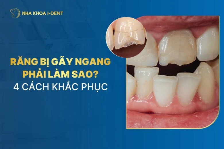 Răng bị gãy ngang phải làm sao? Cách xử lý và khắc phục