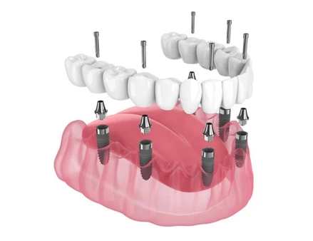 Trồng răng implant toàn hàm All-on-6 tại nha khoa I-Dent.