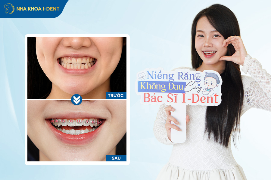 ưu điểm niềng răng mắc cài kim loại