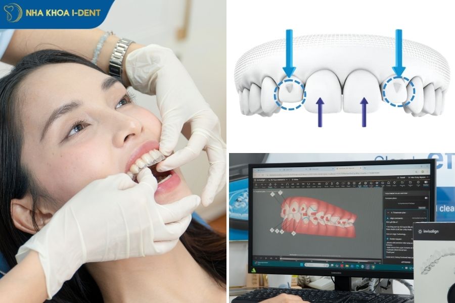 attachment invisalign