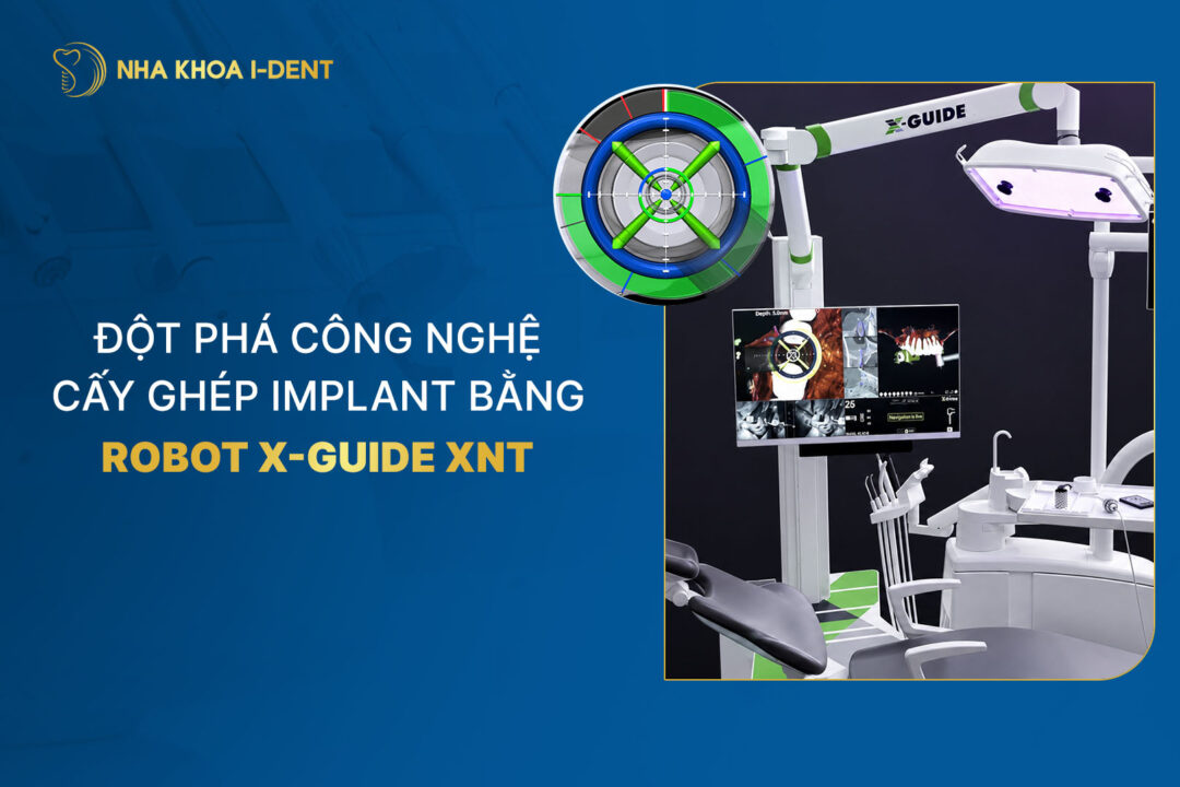công nghệ cấy ghép implant bằng robot x-guide