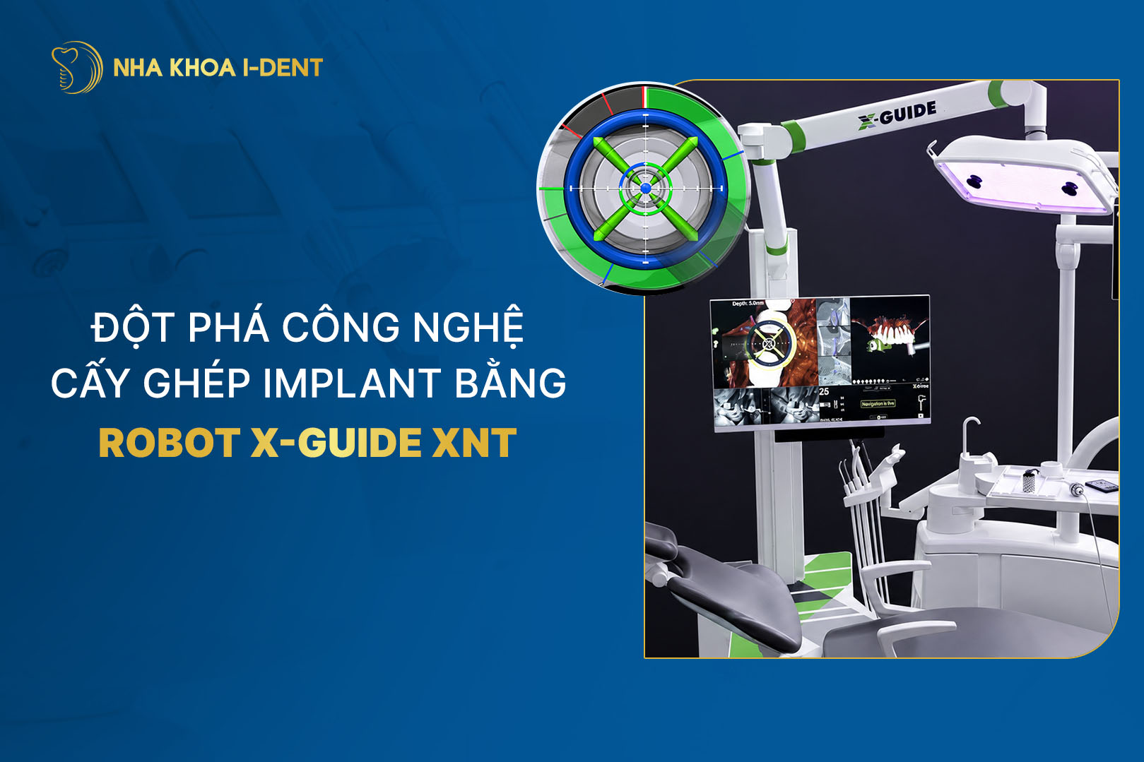 công nghệ cấy ghép implant bằng robot x-guide