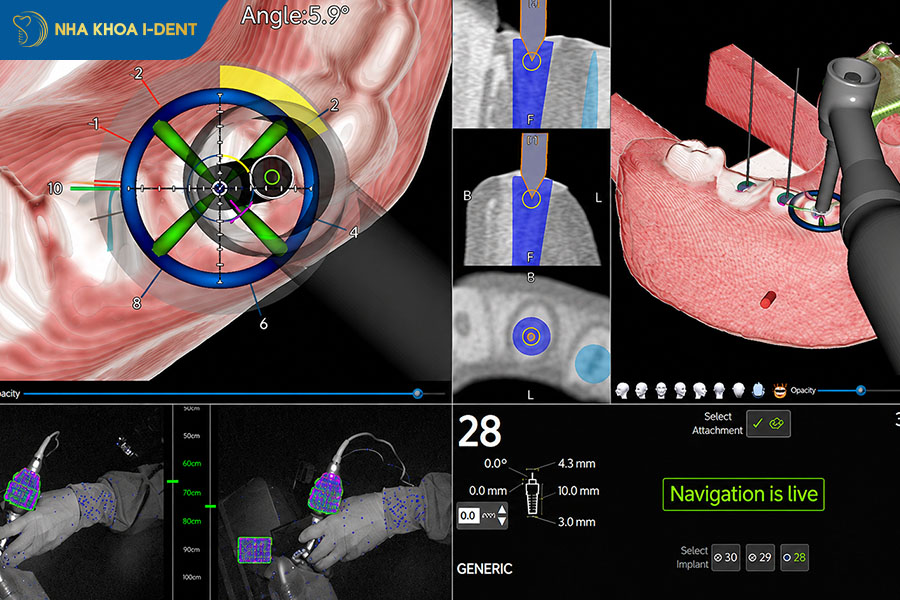 công nghệ cấy implant x-guide