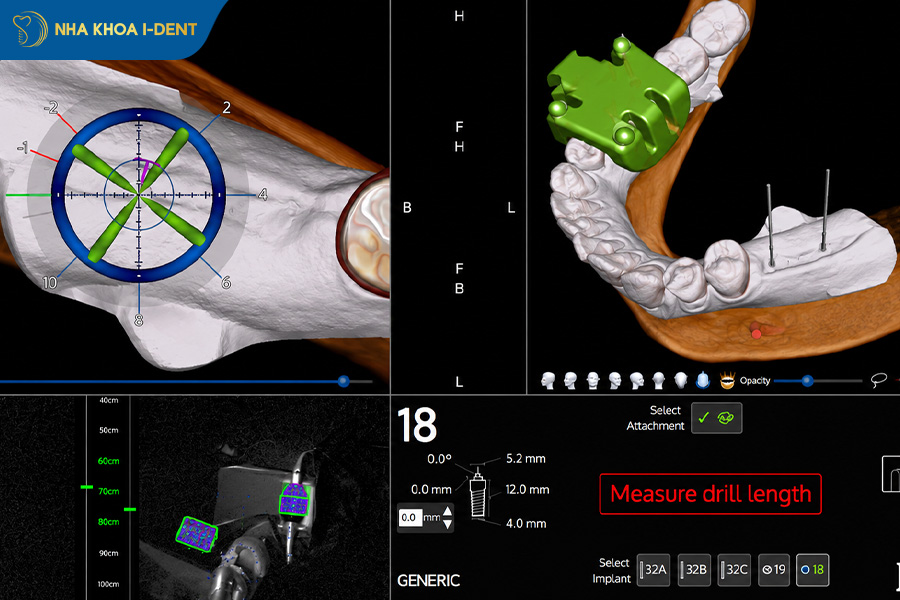 công nghệ cấy ghép implant bằng robot x-guide