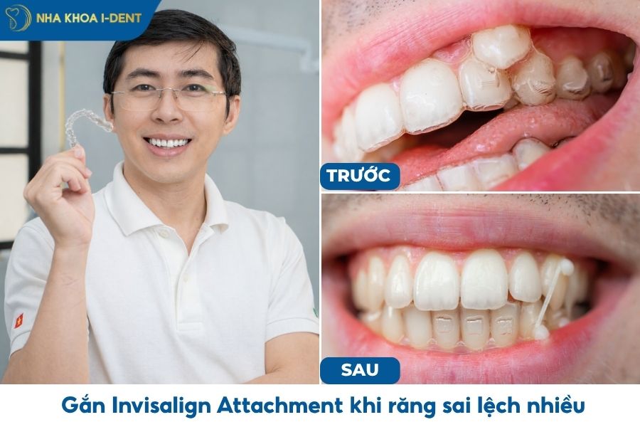 trường hợp gắn attachment invisalign