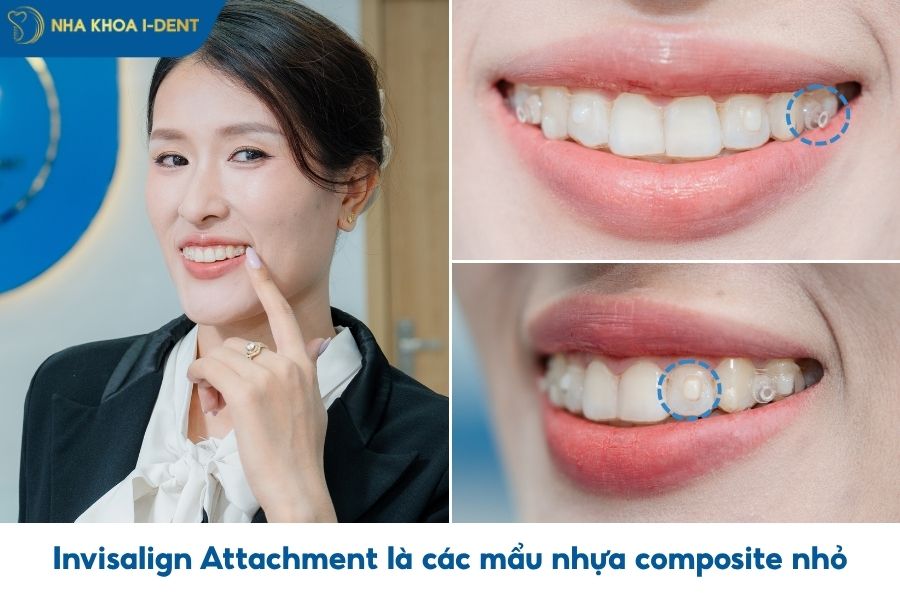 invisalign attachments