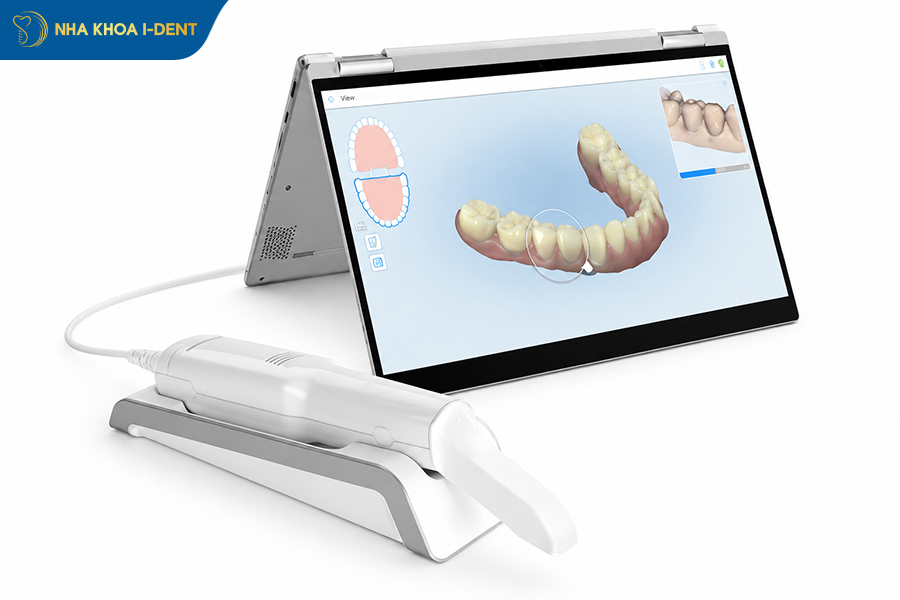itero scanner