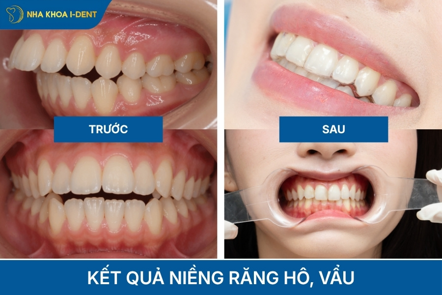 kết quả niềng răng hô