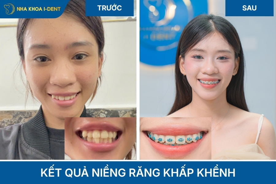 kết quả niềng răng khấp khểnh