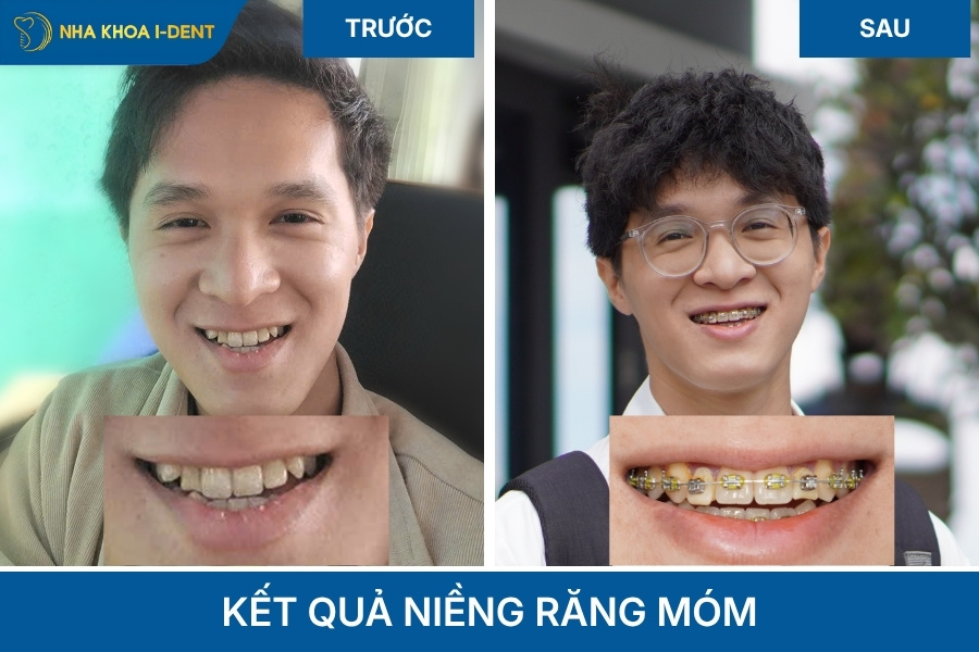 kết quả niềng răng móm