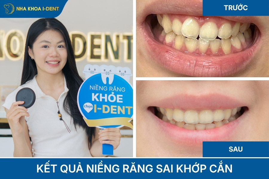 kết quả niềng răng sai khớp cắn