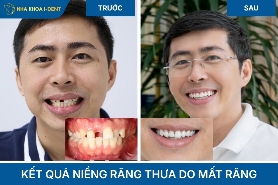 kết quả niềng răng thưa