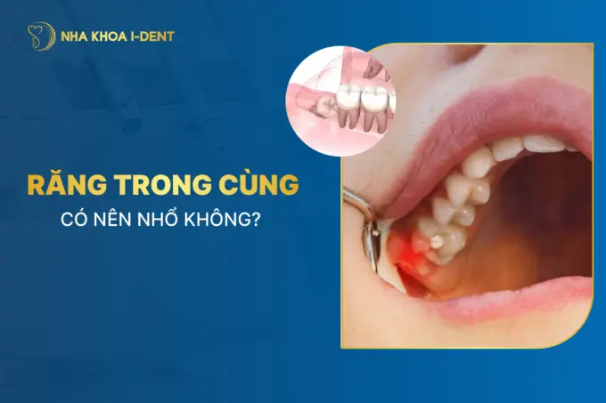 nhổ răng cùng