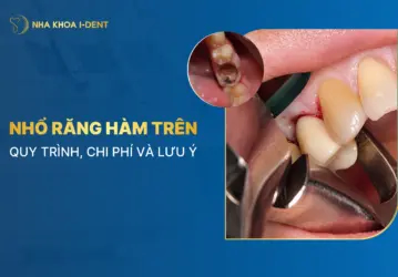 nhổ răng hàm trên